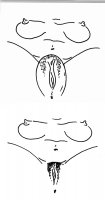 Voorbeeld:  Muschipumpe für besonders pralle Schamlippen